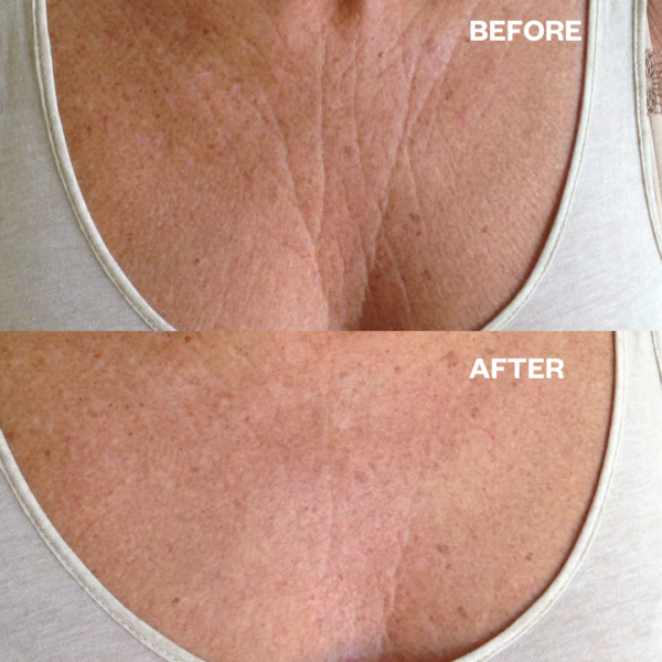 Chest_wrinkles_chest_wrinkle_pad_before_and_after_results_1080x