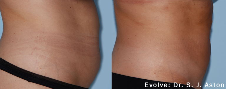 evolve-before-after-dr-sj-aston-preview-1