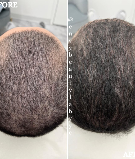 Hair Restoration Package of 4